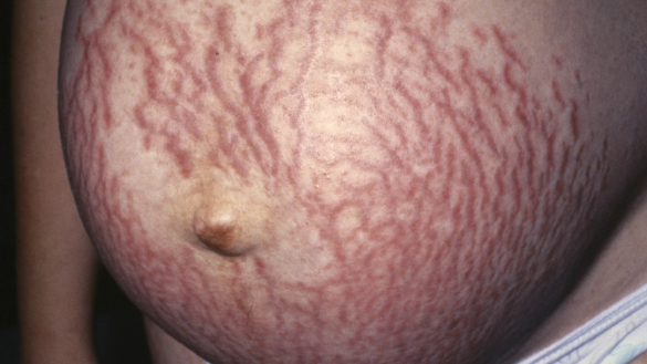 Hudbristningar (Striae)